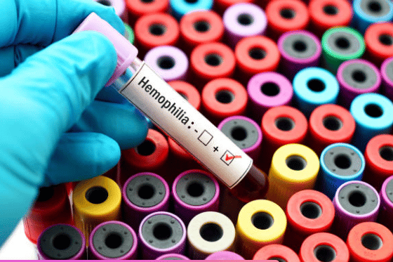 Hlavní diagnostický test na hemofilii je prováděn z krve