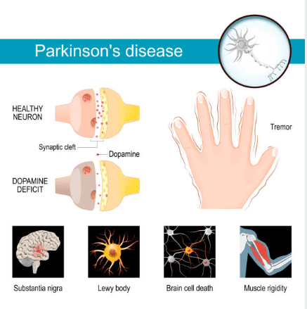 Typické příznaky Parkinsonovy choroby