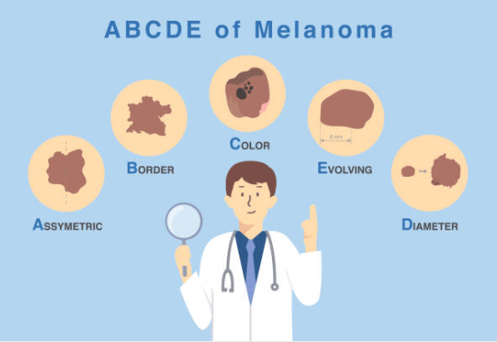 ABCDE metoda jak vypadá melanom