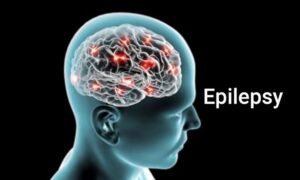 Epilepsie - mozek