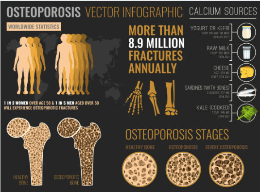 Základní informace o osteoporóze