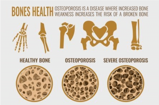 Osteoporóza a její typy. Jaké kosti nejčastěji postihuje.