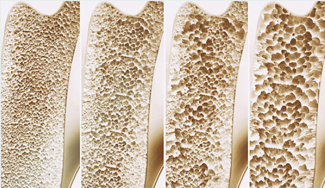Ukázka jak vypadá řídnutí kostí neboli osteoporóza