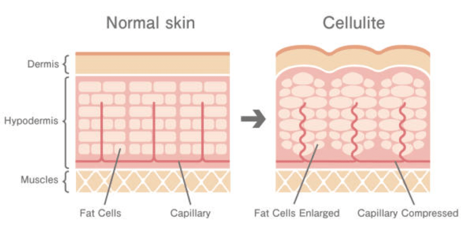 Změny pokožky při celulitidě.
